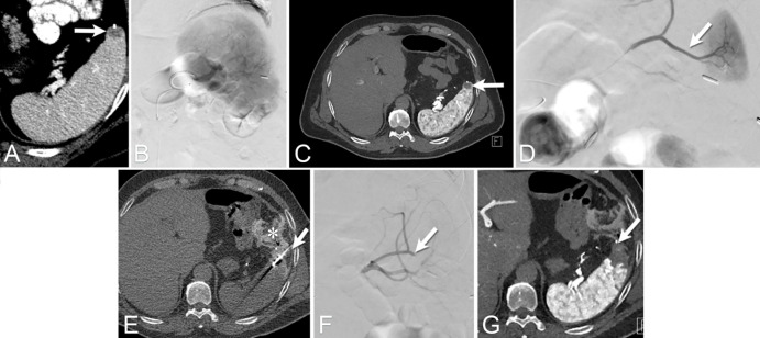 Images from spleen tumor ablation in a 58-year-old man with prior history of colorectal cancer at the splenic flexure with pericolonic adipose tissue invasion, liver metastasis, and enlarging splenic lesion concerning for a spleen metastasis. (A) Diagnostic CT scan shows the spleen metastasis (arrow). (B) Digital subtraction angiography (DSA) image of the splenic artery. (C) CT angiographic image of splenic artery depicts the target lesion (arrow). Note metallic surgical clip anterior to it. (D) DSA image shows microcatheter selection of the polar branch (arrow) supplying the spleen parenchyma adjacent to the lesion. Embolization of this branch was performed with 900-μ beads. (E) CT scan shows microwave antenna (arrow) placement at the target tumor after successful hydrodissection with the displacement of the adjacent colon (*). Immediately after ablation completion and microwave antenna probe removal, the patient became hypotensive and bradycardic. Using the microcatheter located at the splenic artery, (F) DSA image demonstrates successful obliteration of the arterial branch (arrow) and absence of contrast extravasation. The patient became normotensive, and the symptoms were attributed to a self-limited vasovagal event. (G) Postablation CT angiographic image of splenic artery depicts ablation defect at the spleen. The patient remains without local tumor progression at the spleen 3 years after the procedure.