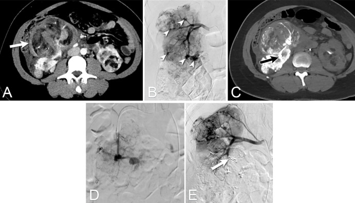 Intra-arterial CT angiographic images in a 33-year-old woman with a family history of tuberous sclerosis who presented with acute abdominal pain. (A) Single-phase (venous) intravenous contrast-enhanced CT scan demonstrates a right perirenal hematoma (arrow) and multiple bilateral renal lesions consistent with angiomyolipoma (AML). (B) Images from urgent digital subtraction angiography (DSA) of the right renal artery shows multiple pseudoaneurysms (arrowheads). There was no active contrast extravasation. (C) CT during renal arteriography was performed to evaluate the relationship between renal artery branches and the perirenal hematoma. Image shows that the branches adjacent to the perirenal hematoma originated from the inferior segmental artery (arrow). (D) Selective DSA of the right inferior segmental artery was performed with a microcatheter, followed by embolization with glue-lipiodol solution. (E) Postembolization DSA image demonstrates successful exclusion of the right inferior segmental renal artery (arrow). In this patient with potential multiple sources of bleeding due to multiple AML, the three-dimensional soft-tissue capabilities of CT were critical to depict the relationship of the perirenal hematoma with the renal artery branches, therefore allowing precise treatment of the culprit vessel while preserving normal renal parenchyma.