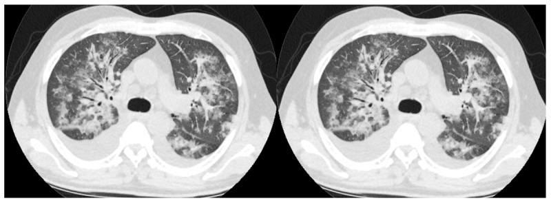 RT-PCR –, CO-RADS 5: This 56-year-old male patient had no comorbidity other than coronary artery disease. He presented to the emergency department with a fever of 38.4 degrees. He had no respiratory symptoms. There were no findings compatible with COVID-19 in laboratory parameters. RT-PCR test was negative, multifocal areas of ground glass and consolidation with bilateral pleural effusion were seen on chest CT taken in his emergency admission, and he was diagnosed with COVID-19 and hospitalized. It was evaluated as CO-RADS 5. PCR tests taken on the 1st, 5th, and 11th days of his hospitalization are also negative. The need for intensive care developed on the 11th day of his hospitalization, and he died on the 17th day