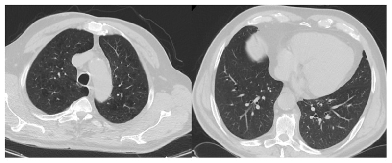 RT-PCR +, CO-RADS 1: This 65-year-old male patient had hypertension, cardiovascular disease, chronic kidney disease, and hyperlipidemia. He presented to the emergency department with shortness of breath and cough. He had hypoxemia. Laboratory parameters compatible with COVID-19 were d-dimer: 990 ng/mL, ferritin: 510 ng/mL, fibrinogen: 443 mg/dL. The patient with positive RT-PCR test and emphysematous changes in both upper lobes of the lungs on CT was hospitalized with the diagnosis of COVID-19. It was evaluated as CO-RADS 1. The patient recovered and was discharged on the 7th day