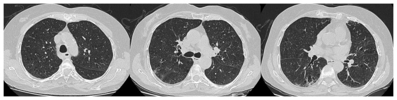 RT-PCR –, CO-RADS 4: This 70-year-old female patient had chronic obstructive pulmonary disease. He presented to the emergency department with a respiratory distress. There are no findings compatible with COVID-19 except d-dimer: 1060 ng/mL CRP: 126 mg/L in laboratory parameters. He was admitted to the intensive care unit with the diagnosis of COVID-19, with negative SARS-CoV-2 PCR test and unilateral ground glass oppacities with emphysema and bronchiectasis on chest CT. It was evaluated as CO-RADS 4. PCR tests on day 1 and day 6 are negative. He died on the 9th day of his hospitalization