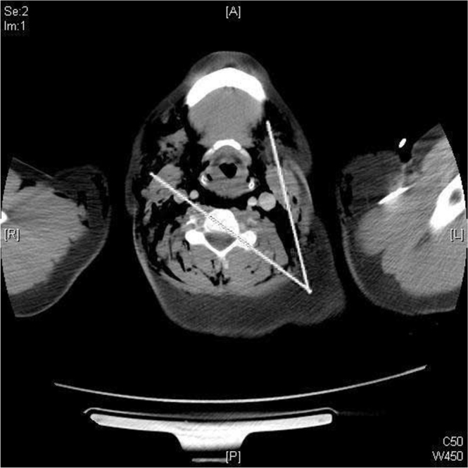 Spontaneous pneumomediastinum with severe subcutaneous emphysema ...