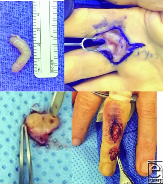 graphic file with name eplasty18ic08_fig1.jpg