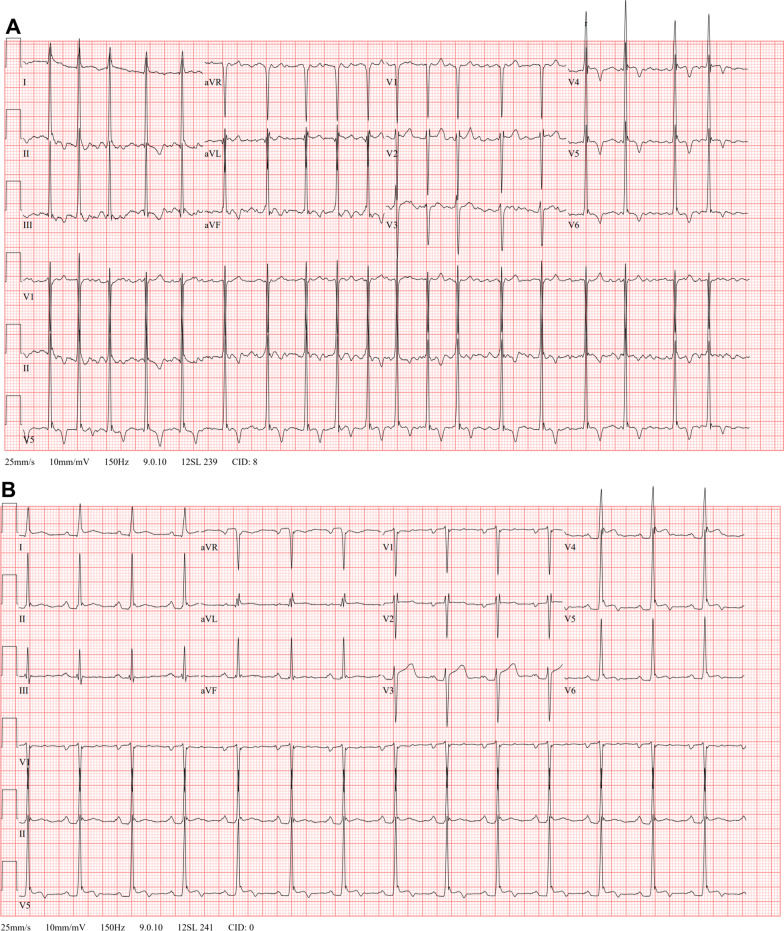 gabapentin overdose pubmed