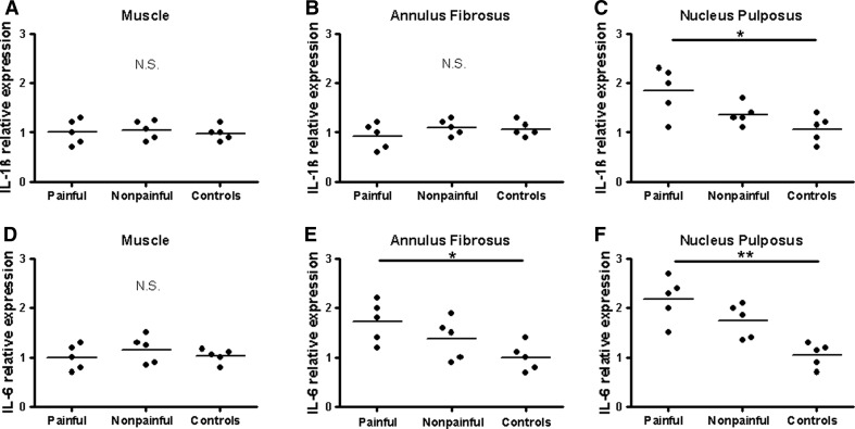 elevated-il-1-and-il-6-levels-in-lumbar-herniated-discs-in-patients
