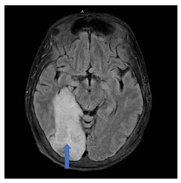 A rare case of horseshoe kidney with multiple atrial myxomas presenting