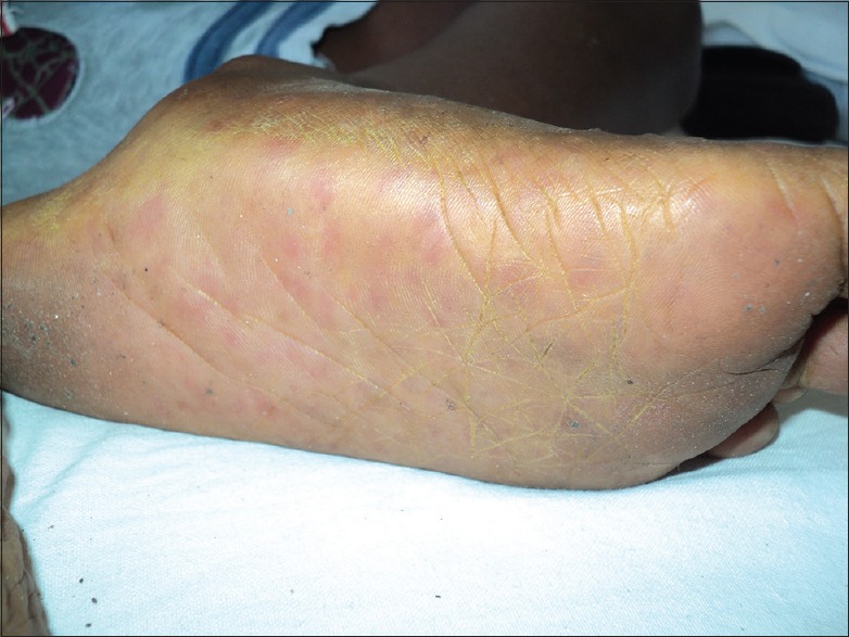 Eczema Coxsackium - PMC