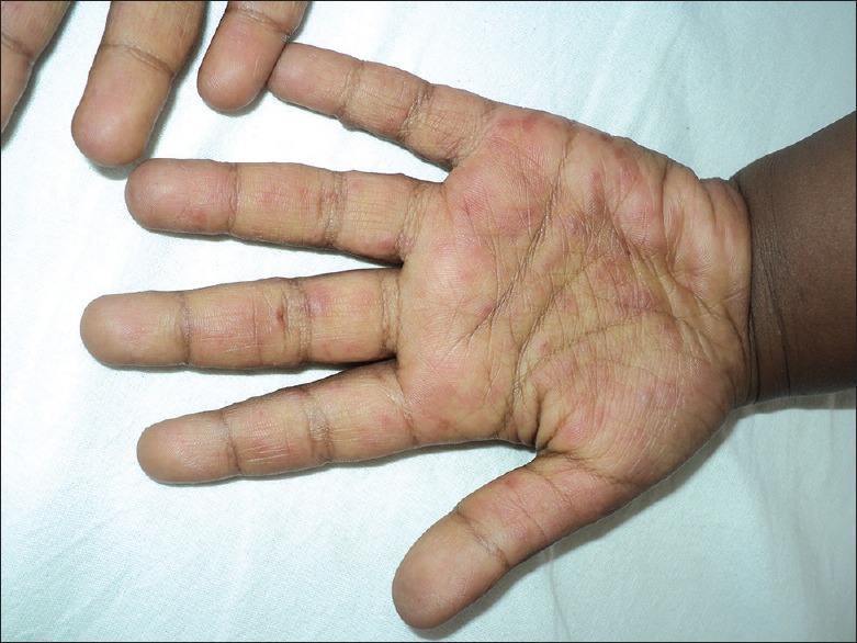 Eczema Coxsackium - PMC