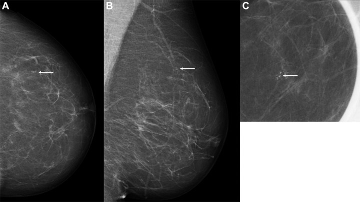 Images in a 60-year-old woman with an invasive screen-detected cancer with an artificial intelligence (AI) score of 1 on the screening mammograms. (A) Mammogram of left breast from craniocaudal view. (B) Mammogram of left breast from mediolateral oblique view. (C) Craniocaudal cone view mammogram with magnification. AI score is defined as the overall examination-level score from the AI system, and a score of 1 is indicative of low probability of breast cancer and 10 of high probability. The arrows indicate the malignancy.