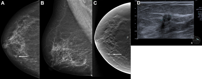 Images in a 68-year-old woman with a screen-detected ductal carcinoma in situ with an artificial intelligence (AI) score of 10 on the screening mammograms. (A) Mammogram of right breast from craniocaudal view. (B) Mammogram of right breast from mediolateral oblique view. (C) Craniocaudal digital breast tomosynthesis image of right breast. (D) US image of right breast. AI score is defined as the overall examination-level score from the AI system, and a score of 1 is indicative of low probability of breast cancer and 10 of high probability. The arrows in A and C indicate the malignancy, and the dotted line in D indicates the tumor diameter.