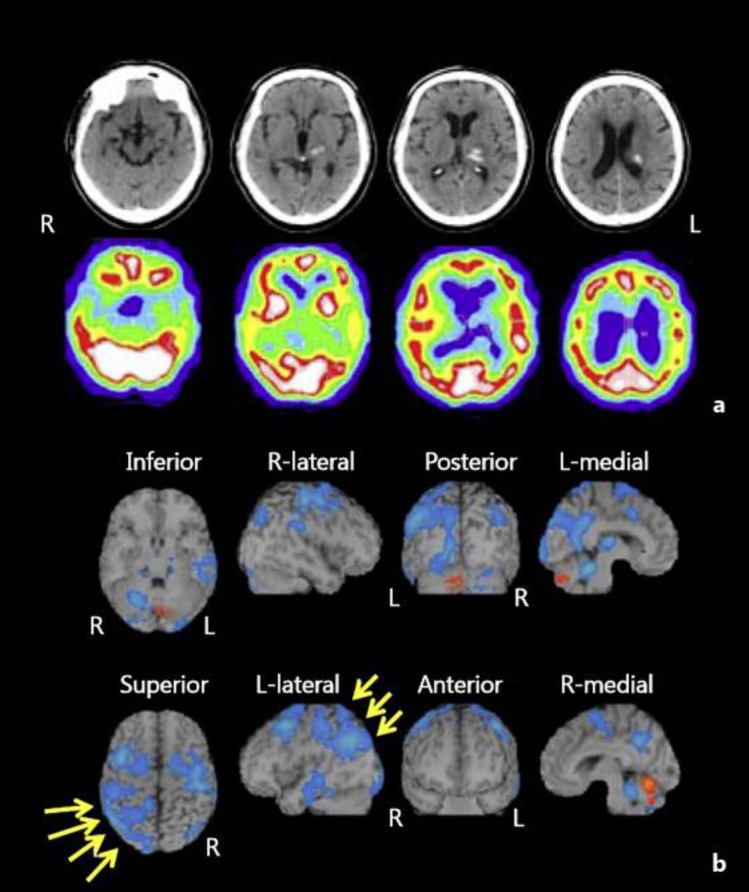 Agraphia Caused by Left Thalamic Hemorrhage - PMC