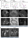Figure 6. Preliminary biomarker and clinical activity of vimseltinib in patients with TGCT. A, Increases in the CSF1R ligands CSF1 and IL34 in plasma, and decrease of levels of CSF1R-dependent nonclassical monocytes in blood in vimseltinib-treated patients. Decrease in tumor burden in patients with TGCT, in the right knee of patient 1 (B) and the right hip of patient 2 (C). Patient 3 did not consent to release of MRI images.