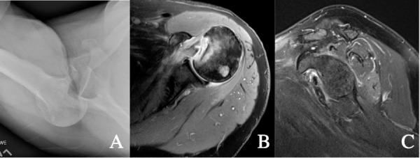 A close-up of a mri of a shoulder Description automatically generated