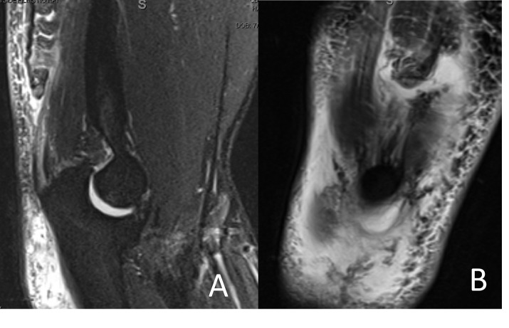 A close-up of a mri scan of a leg Description automatically generated