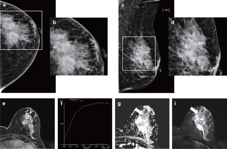 Diagnostic performance of DCE-MRI, multiparametric MRI and ...