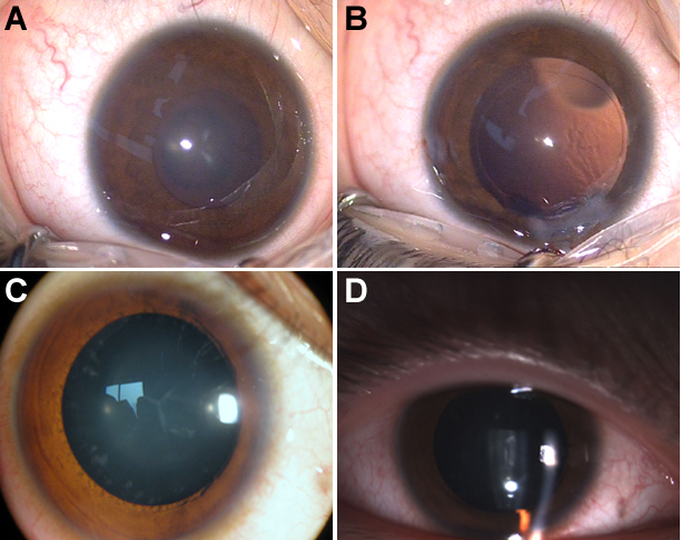 A G→T splice site mutation of CRYBA1/A3 associated with autosomal ...