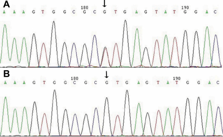 A G→T splice site mutation of CRYBA1/A3 associated with autosomal ...