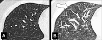 Tree-in-bud: Transverse CT images of the middle lobe. (A) While the
standard reconstruction shows several micronodules only, (B) the maximum
intensity projection reveals the tree-in-bud appearance of these micronodules
(arrow). 