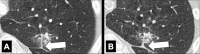 Nodule, pleural tag: Transverse CT images of the left lung show complex
nodule with single pleural tag (arrow), (A) thin at first appearance, and (B)
thickening over time. 