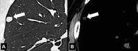 Nodule: Transverse CT images in (A) lung and (B) soft tissue windows of
the right lung show an ovoid soft tissue nodule (arrow). 