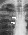 Paratracheal stripe: Frontal chest radiograph shows right paratracheal
stripe (arrows). 