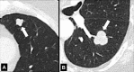 Lobulation: Transverse CT images of the left (A) upper and (B) lower lobes
show lobulated nodules (arrow). 