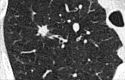 Nodule: Transverse CT image of the right upper lobe shows an irregular
nodule with mild spiculation. 
