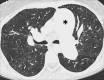 Oligemia: Transverse contrast-enhanced CT image shows oligemia caused by
vascular arterial disease. Note the substantially dilated central pulmonary
arteries (asterisk). 