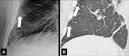 Septal lines: (A) Frontal chest radiograph and (B) coronal CT image
reconstruction show septal lines (arrows), formerly called Kerley B lines. 