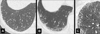 Reticular: Transverse CT images in three different patients show (A)
subtle, (B) moderate, and (C) severe reticular opacities, with ground-glass
opacities. 