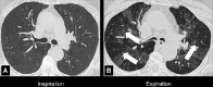 Air trapping: Transverse CT image at the level of the carina in (A)
inspiration and (B) expiration. While the lung parenchyma in inspiration (A) is
homogeneous, expiration (B) reveals failure of lung density to increase in areas
of air trapping (arrows). 