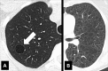 Cyst: Transverse CT images of the (A) right and (B) left lung of two
different patients. Cysts are solitary (arrow) in A and diffuse in B. 