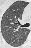 Diffuse: Transverse CT image of the right lung shows diffuse increase in
lung attenuation caused by confluent ground-glass nodules. 