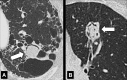 Mycetoma: Transverse CT images of the left upper lobe in two different
patients show mycetomas (arrow) in preexisting cavities with air crescent
surrounded by (A) abnormal and (B) normal lung parenchyma. The mycetoma in B
shows sponge-like appearance. 
