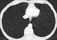 Panlobular: Transverse CT image shows panlobular emphysema. 