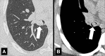 Endobronchial: Transverse CT images in (A) lung and (B) mediastinal window
through the right lung show partially obstructing endobronchial lesion in the
bronchus intermedius (arrow). 