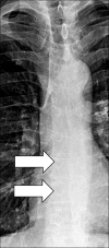 Azygo-esophageal recess: Frontal chest radiograph of the mediastinum shows
the azygo-esophageal recess (arrows). 