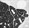 Secondary pulmonary lobule: Transverse CT image of the right lower lobe
shows secondary pulmonary lobule surrounded by thickened interlobular septa
(arrows). 