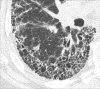 Fibrosis: Transverse CT image of the right lower lobe shows extensive
fibrosis with honeycombing and reticular opacities. 