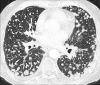 Nodular: Transverse contrast-enhanced CT image of the lungs shows diffuse
nodular pattern. 