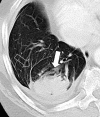 Atelectasis: Transverse CT image of the right lower lobe shows rounded
atelectasis (solid arrow) adjacent to thickened pleura and a small pleural
effusion, and “comet tail” (open arrow). 