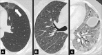 Ground-glass opacity: (A–C) Transverse CT images of the left lung
of three different patients show ground-glass opacities. Opacity is subtle and
focal in A (arrow), subtle and diffuse with centrilobular nodules in B, and
severe and diffuse with mild reactive airway dilatation in C. 