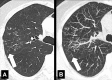 Tree-in-bud: Transverse CT image of the right lung in (A) thin-section and
(B) maximum intensity projection reconstructions show focal tree-in-bud
opacities (arrow). 