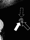 Nodule: Transverse CT image of the left lower lobe shows a complex nodule
with fat (solid arrow), calcium (open arrow) and soft tissue (dashed arrow)
components. 