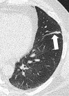 Atelectasis: Transverse image of the left upper lobe shows linear
atelectasis along the major fissure (arrow). 