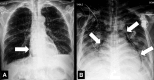 Pneumopericardium: (A, B) Frontal chest radiographs in two patients show
air in the pericardial cavity (arrows). 