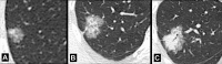 Nodule: (A–C) Transverse CT images of the right lung of three
different patients show a complex nodule with solid and ground-glass components
(part-solid nodules). While the ground-glass component is predominantly present
in A, the solid component is larger in B and becomes the dominant component in
C. 