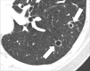Cavity: Transverse CT image of the left lower lobe shows two round
gas-filled structures (arrows). 
