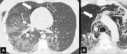 Pneumomediastinum: (A, B) Transverse CT images in two patients show
mediastinal (solid arrow) and extrapleural (open arrow) air collections. 