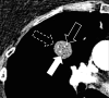 Nodule: Transverse CT image of the right upper lobe shows a complex nodule
with fat (solid arrow), calcium (open arrow) and soft tissue (dashed arrow)
components. 